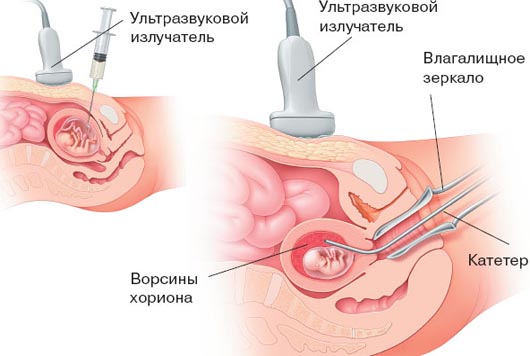 Процедура биопсии хориона